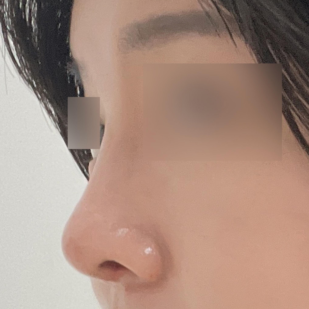 Mình đã phẫu thuật nâng mũi~! 