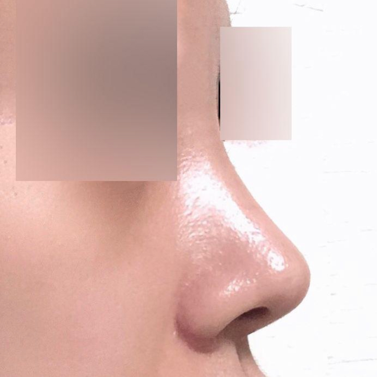 Mũi ngắn và tẹt đã trở nên cao hơn