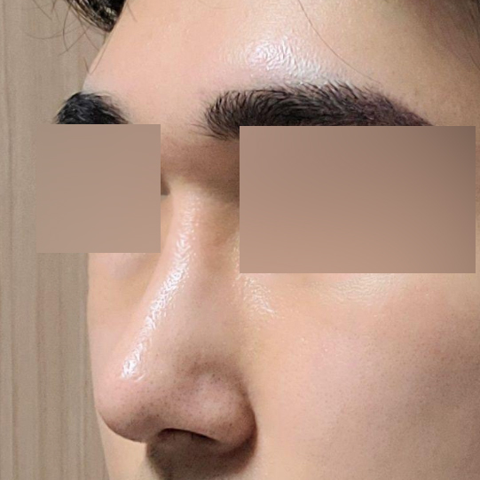 Đánh giá sau một tháng phẫu thuật mũi