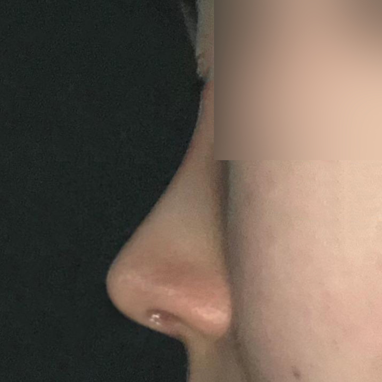 Mình đã phẫu thuật mũi với bác sĩ Seo Seung-jo được 1 tháng rồi!