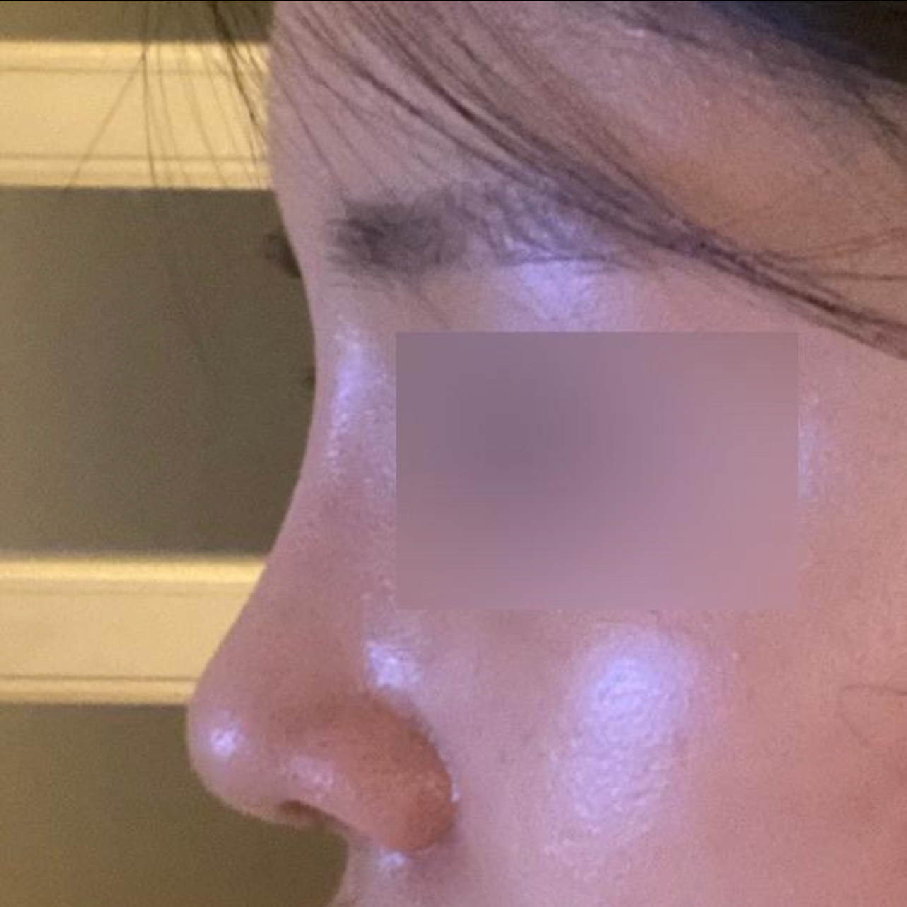 Đánh giá sau một tháng phẫu thuật với bác sĩ Seo Seung-jo