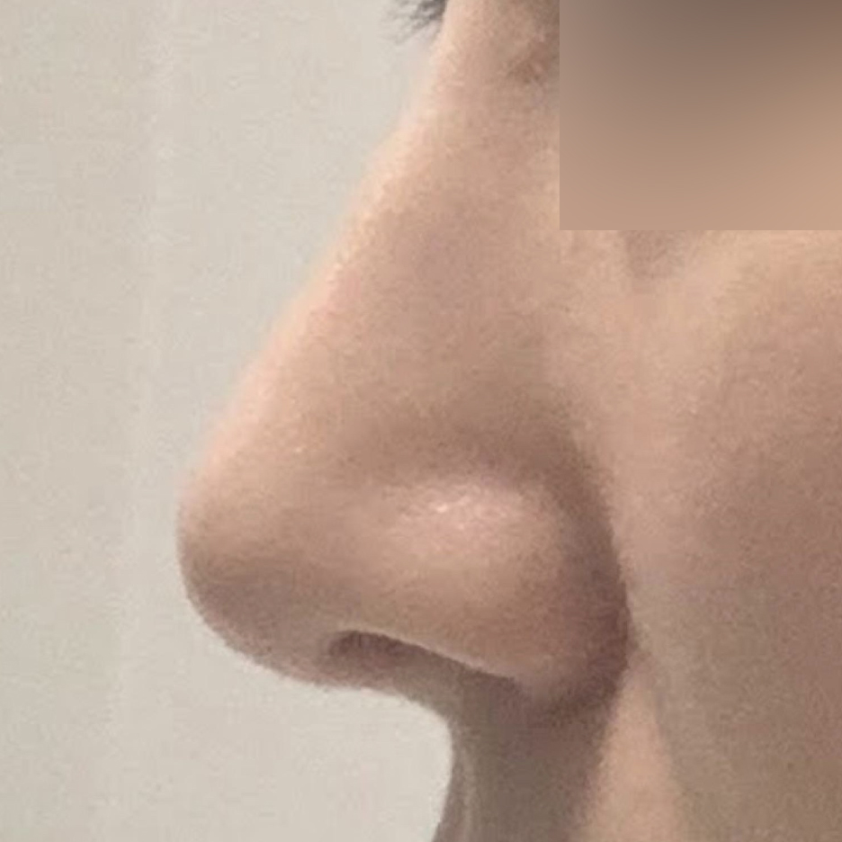 Đã gần 4 tháng kể từ khi mình phẫu thuật mũi