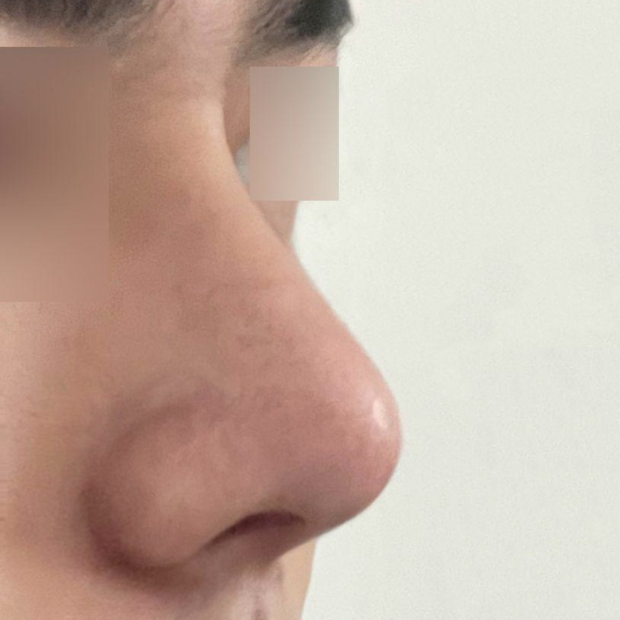 Mình đã phẫu thuật với bác sĩ Shim Jung-hwan được 1 tháng rồi.