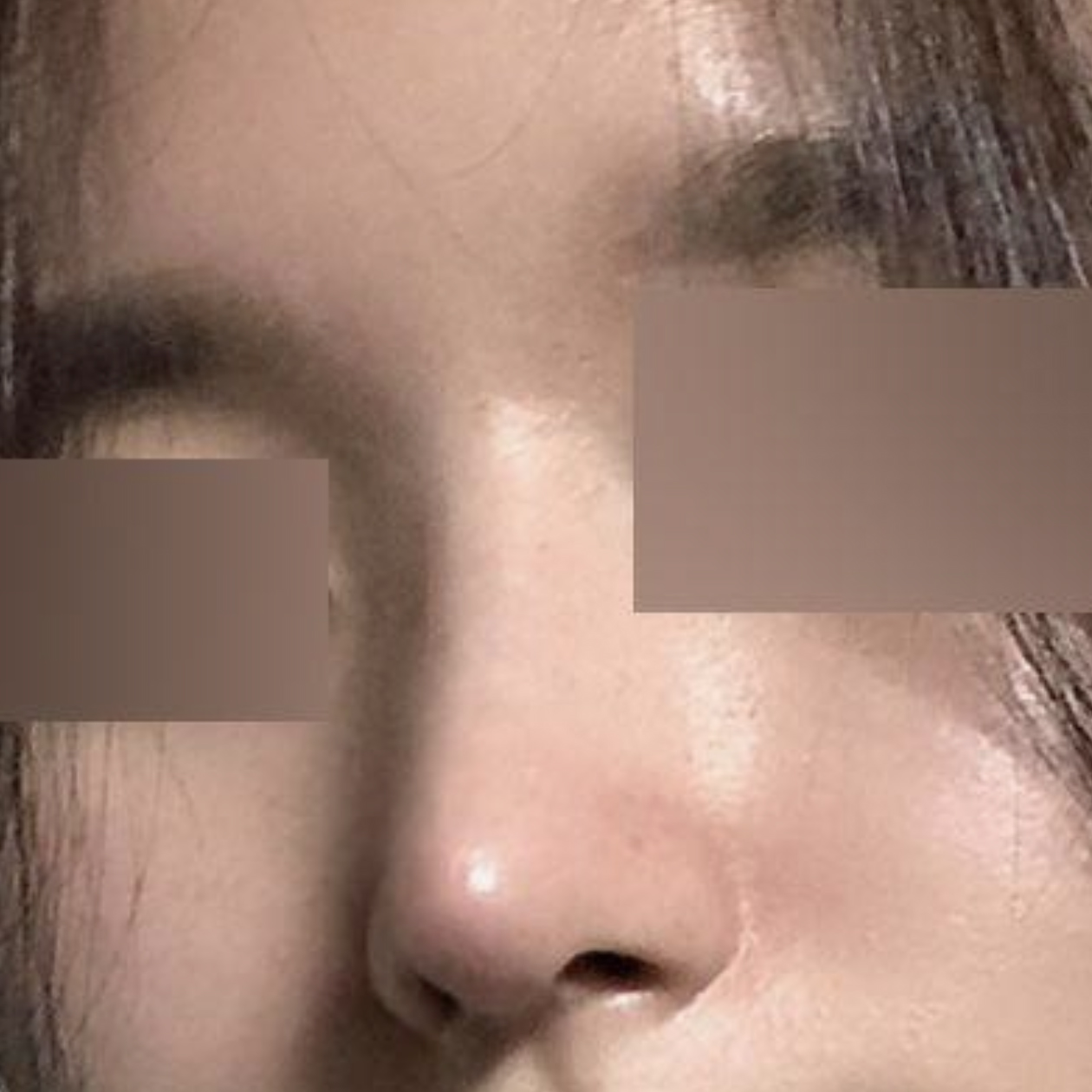 Đã 2 tháng kể từ khi mình phẫu thuật nâng mũi dáng thẳng