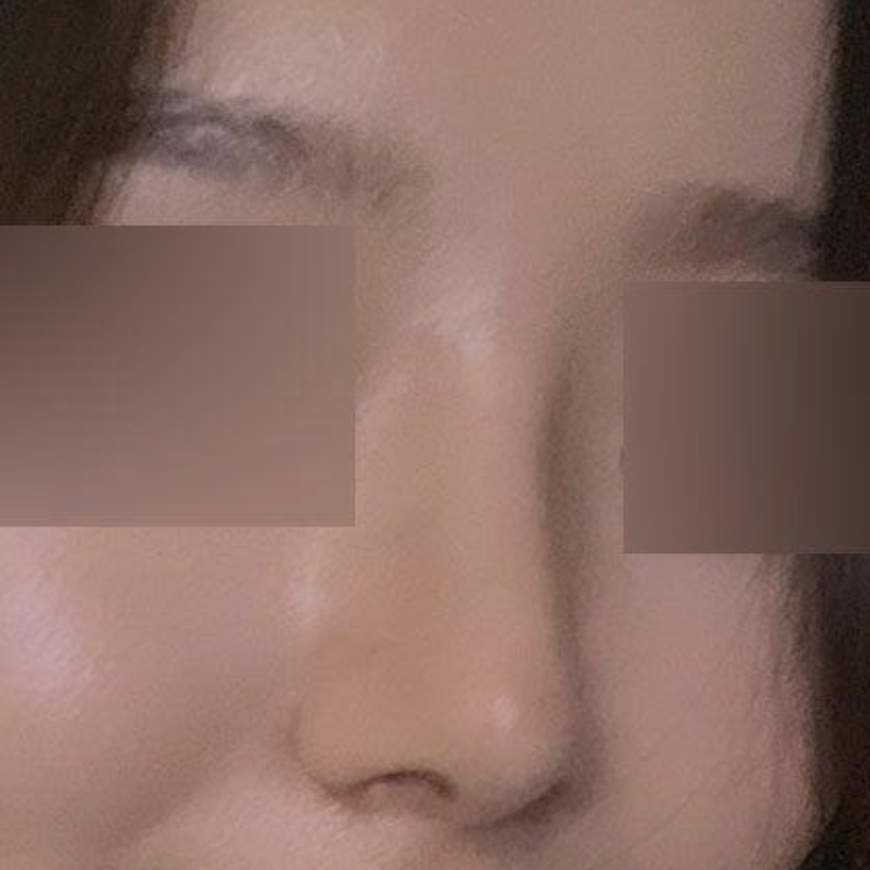 Cuối cùng cũng được 2 tháng kể từ khi phẫu thuật tại Weavers