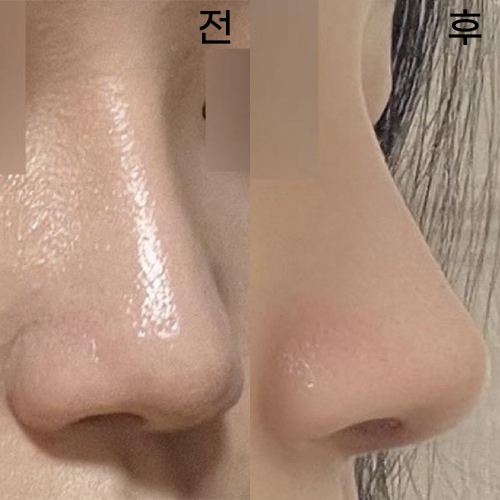 Đã được 1 tháng kể từ khi mình tái phẫu thuật mũi với bác sĩ trưởng khoa