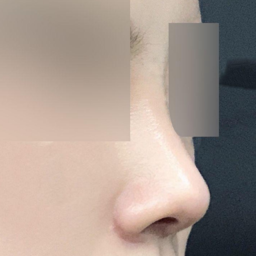 Mình đã phẫu thuật mũi được một tháng rồi!