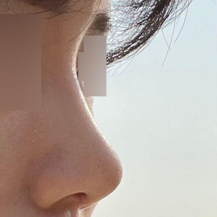 Hôm nay cuối cùng mình đã đi cắt chỉ bên trong!