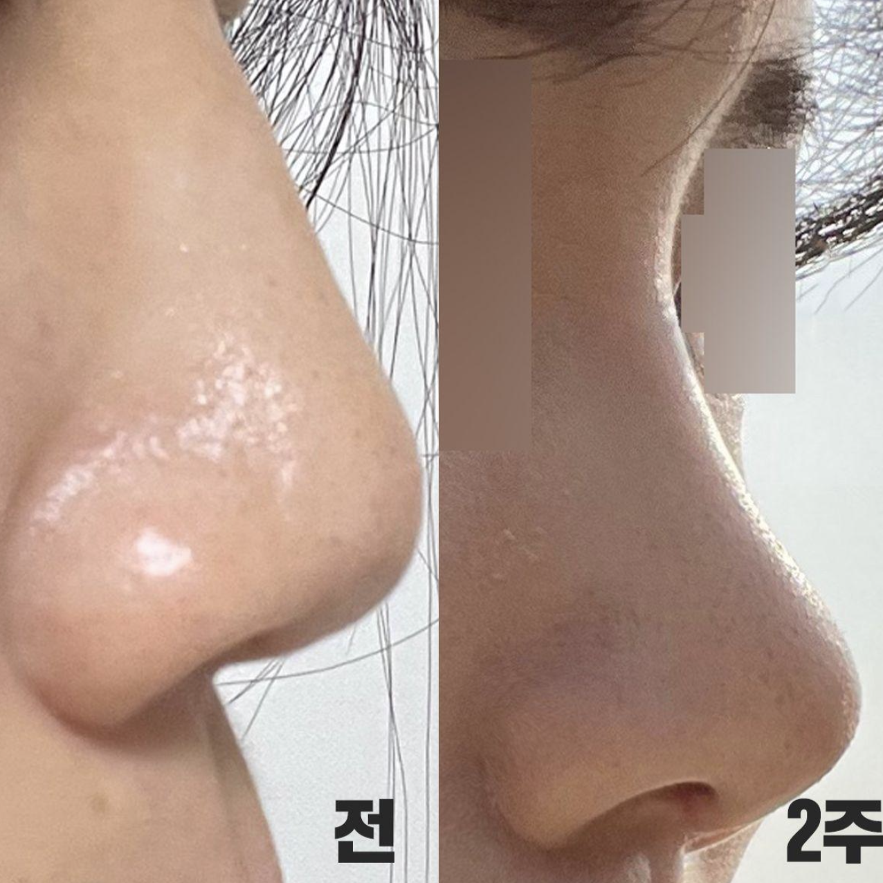 Mình đã phẫu thuật mũi được một tháng rồi!