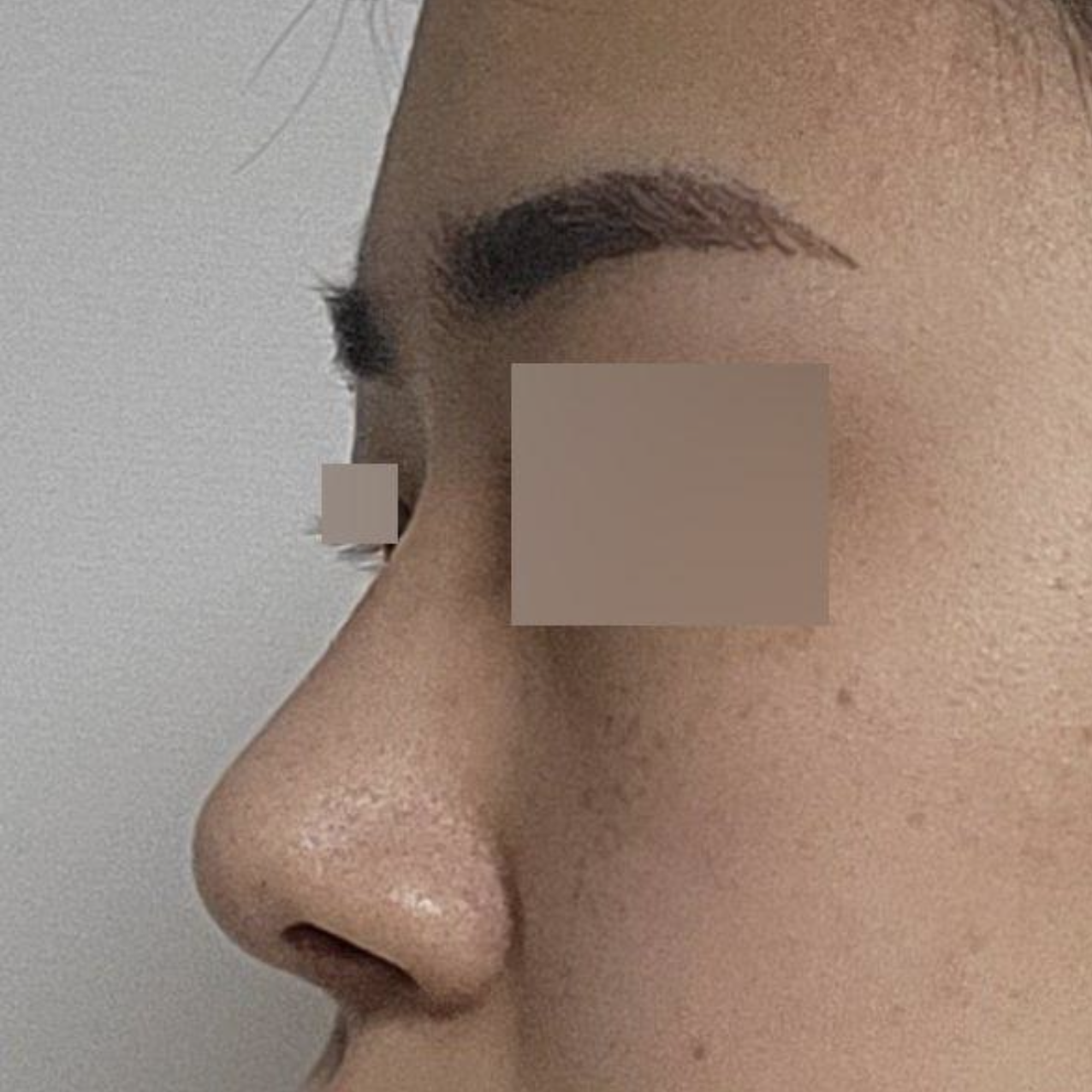 Mình đã phẫu thuật được 3 tháng rồi.