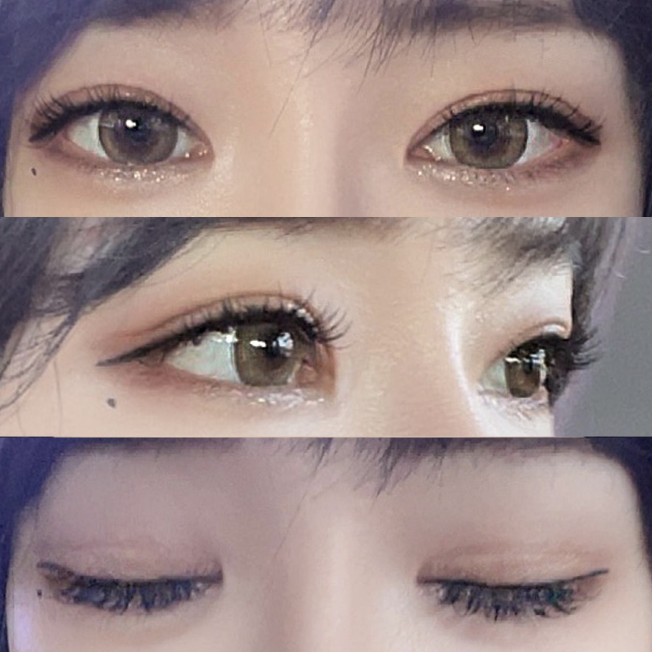 Đã 4 tháng kể từ khi mình phẫu thuật lại mắt.