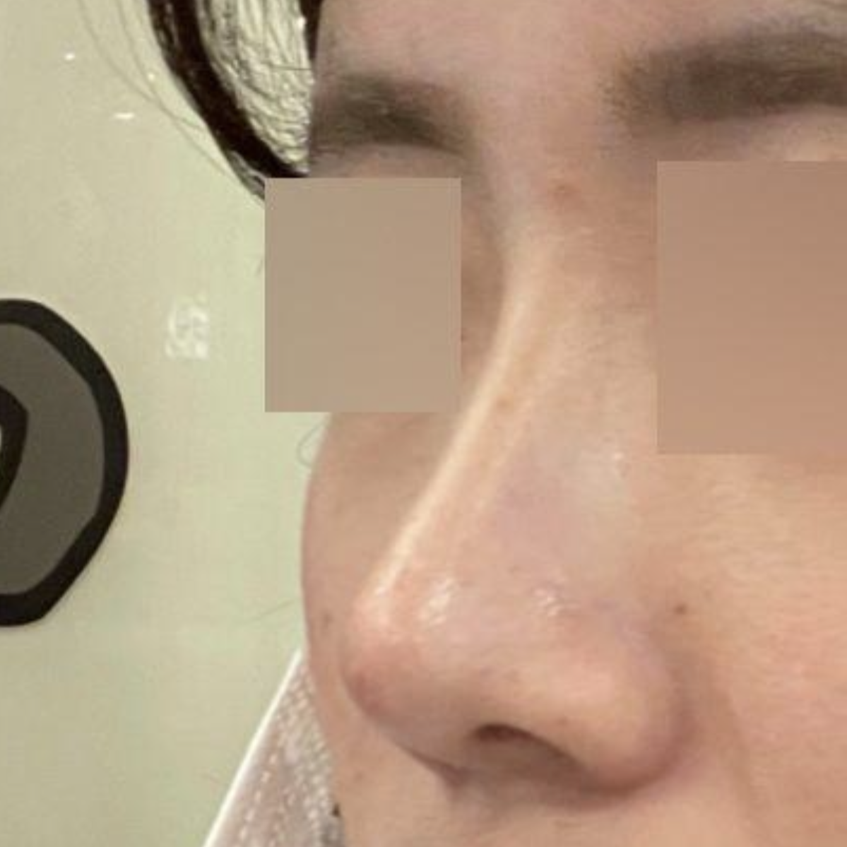 Đã được hai tháng kể từ khi mình phẫu thuật mũi!