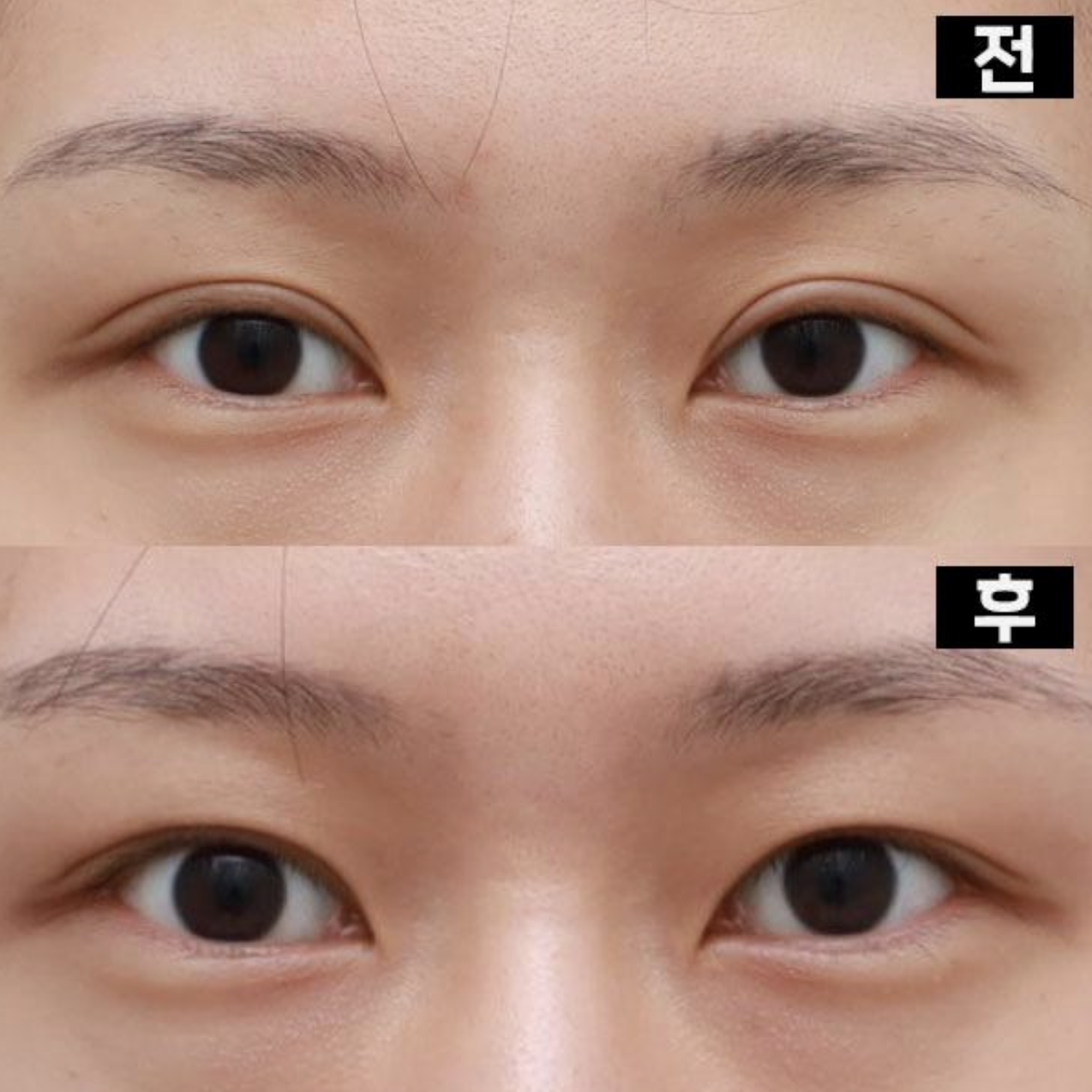 Mình đã phẫu thuật lại mắt xúc xích và chỉnh sửa mí mắt!