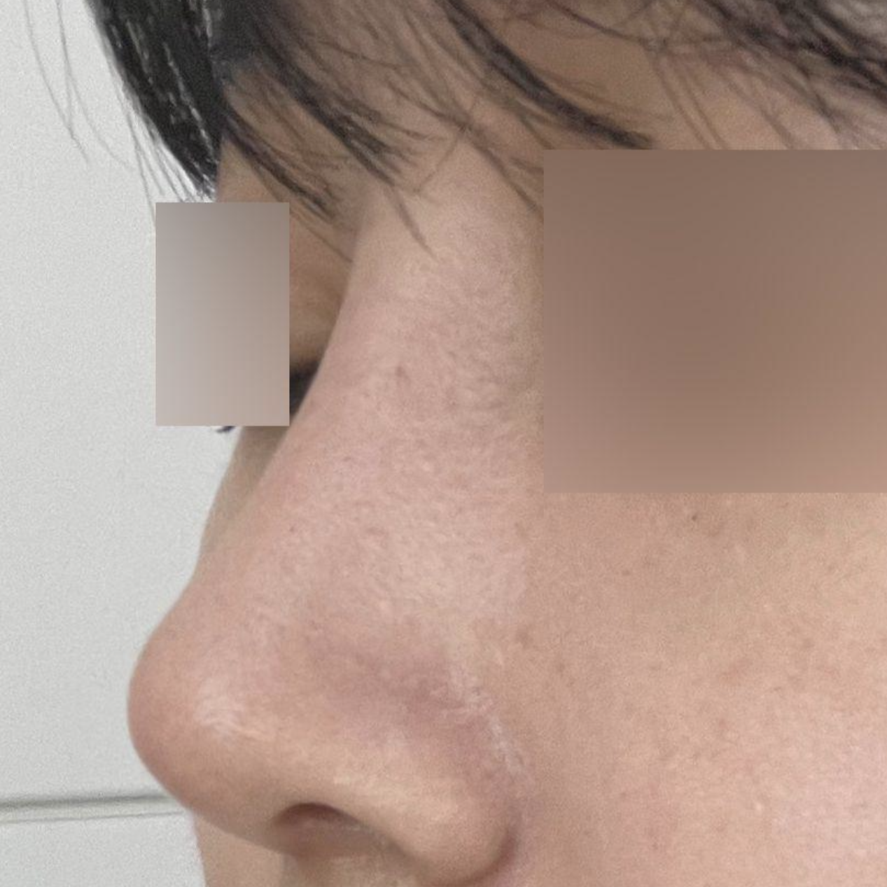 Đã thành công sau một tháng phẫu thuật mũi!