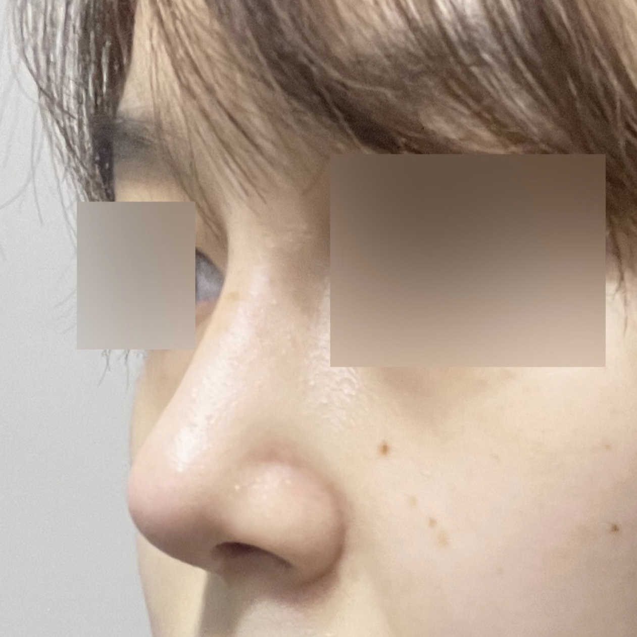 Review sau một tháng sau khi phẫu thuật lại mũi tại Bệnh viện thẩm mỹ Weavers~! 