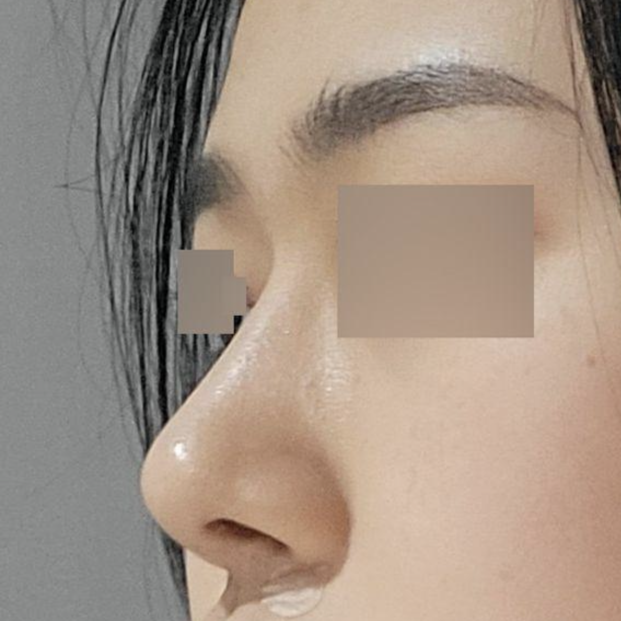 Đã 5 tháng kể từ khi mình phẫu thuật tại Weverse