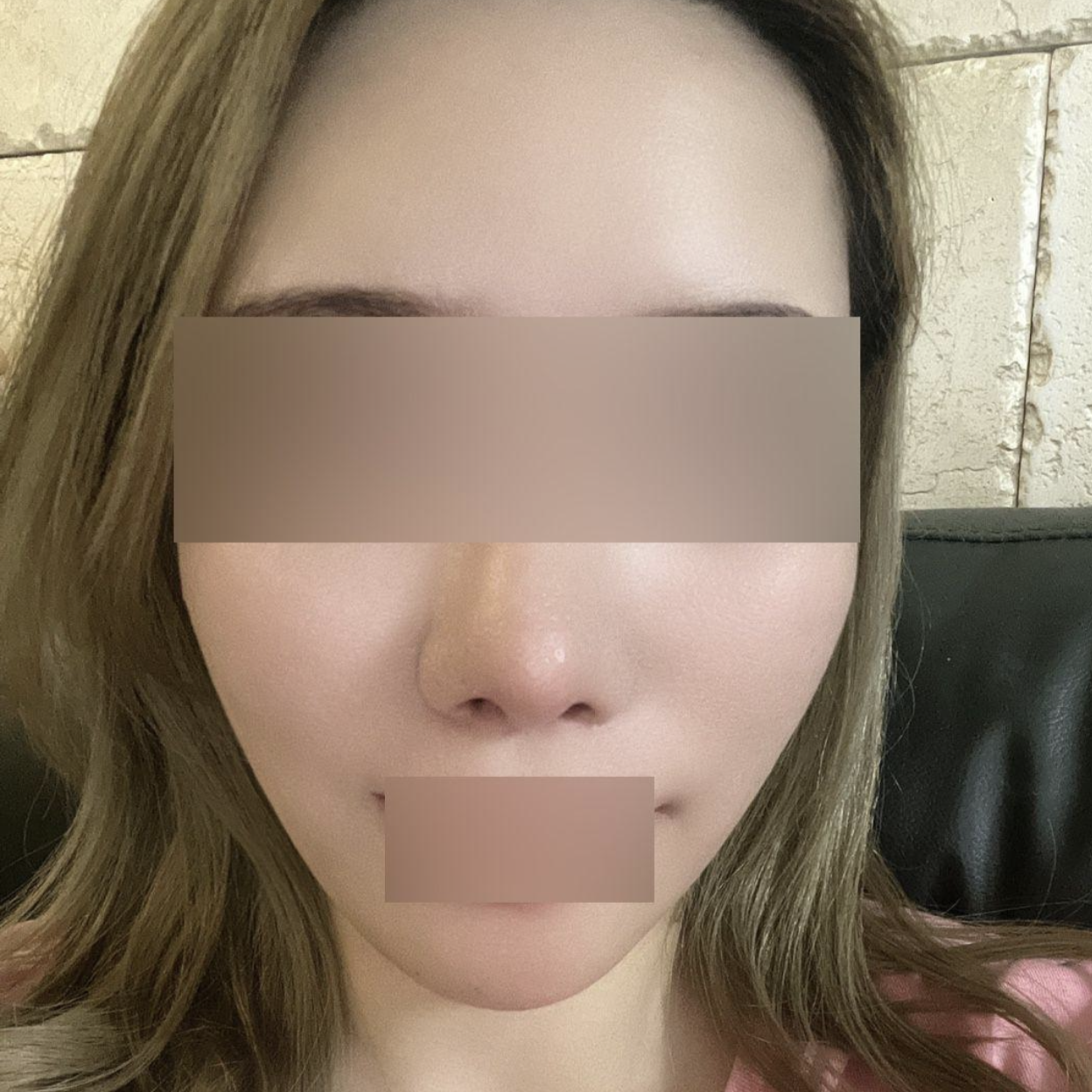 Mình đã thực hiện căng chỉ được hai tháng rồi ~