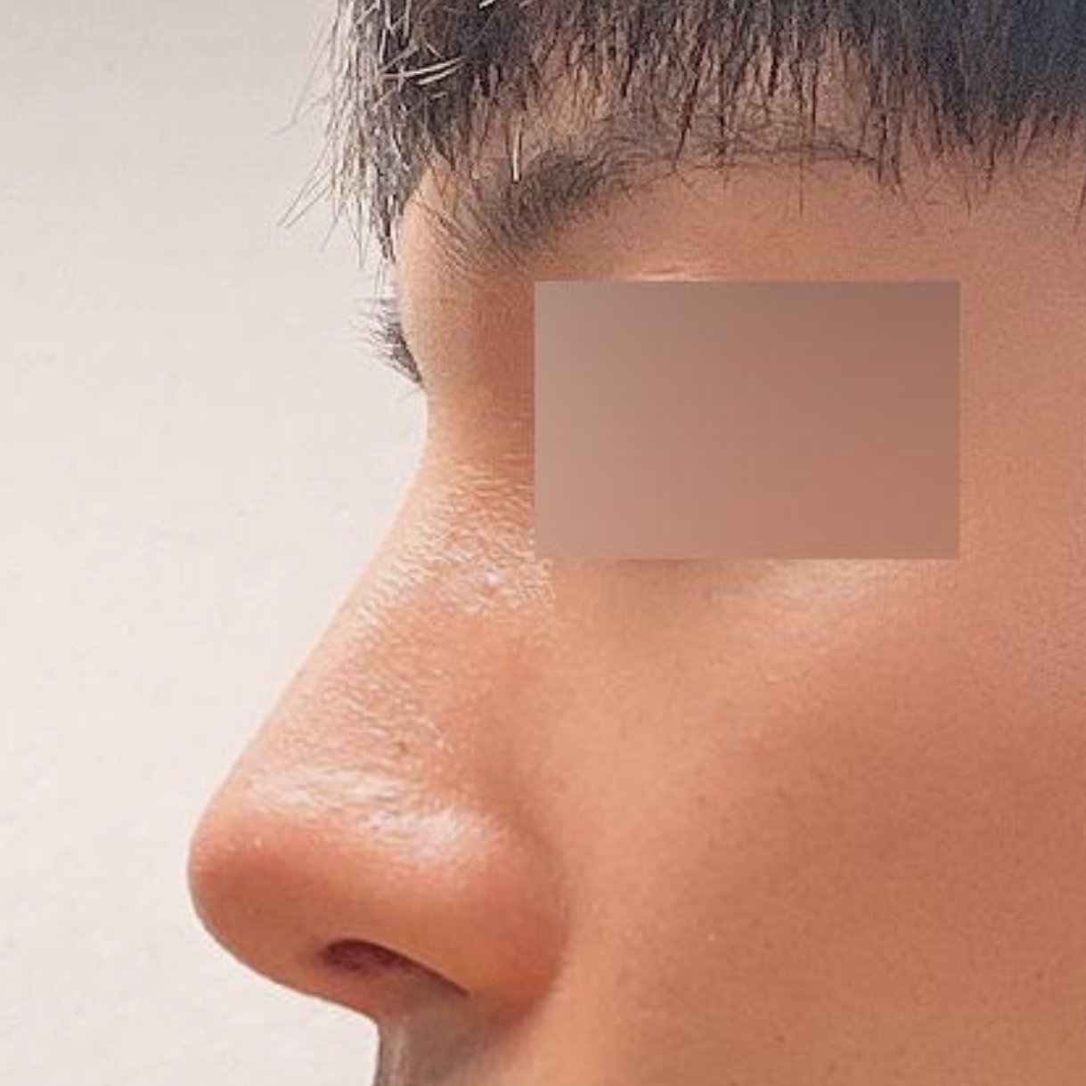 Đã sáu tháng kể từ khi mình phẫu thuật tại Bệnh viện thẩm mỹ Weavers