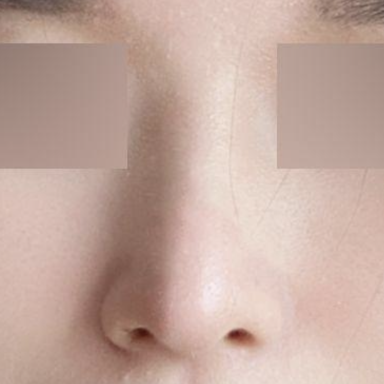 Đã 6 tháng kể từ khi phẫu thuật mũi