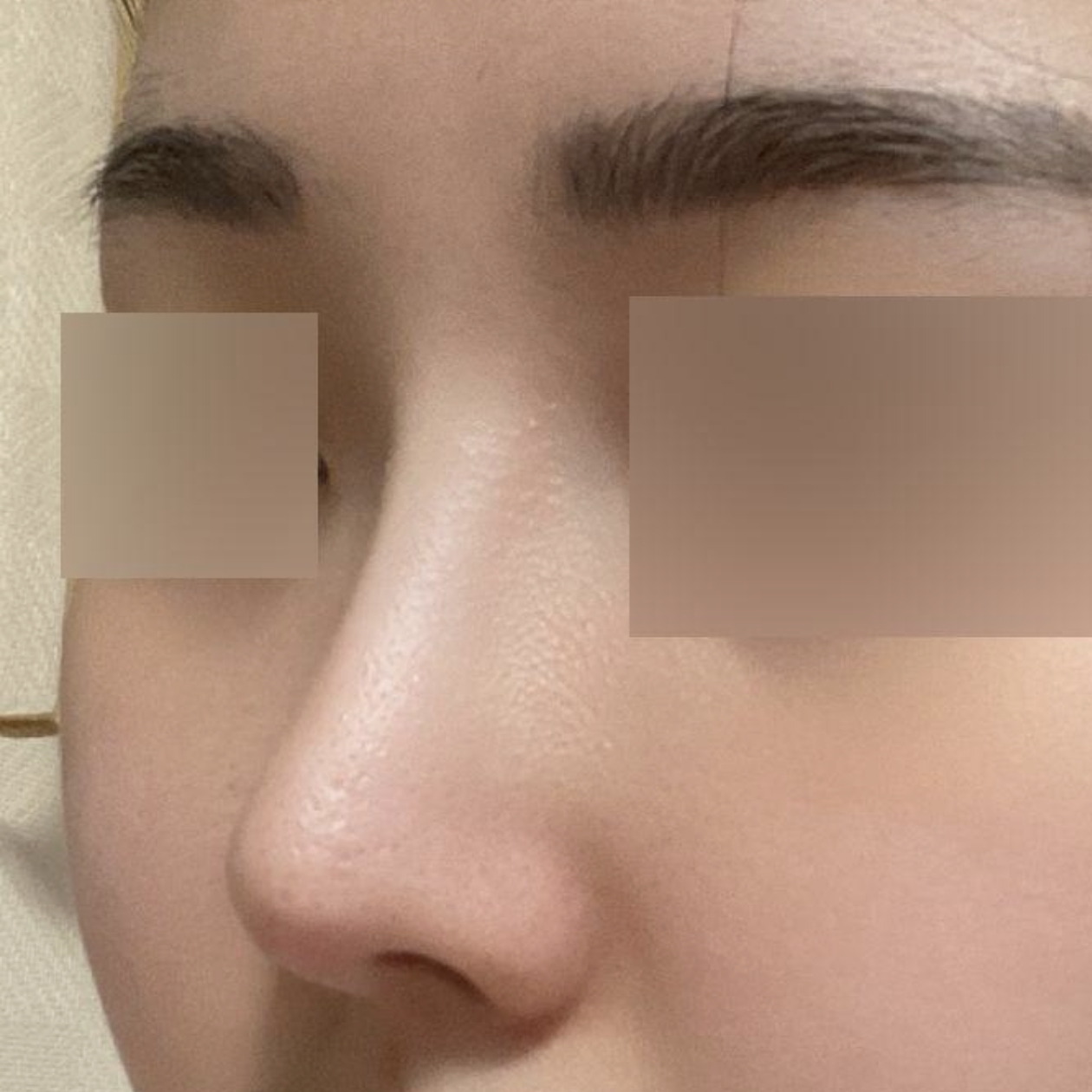 Đã 6 tháng kể từ khi mình phẫu thuật mũi kết hợp điều trị viêm mũi dị ứng