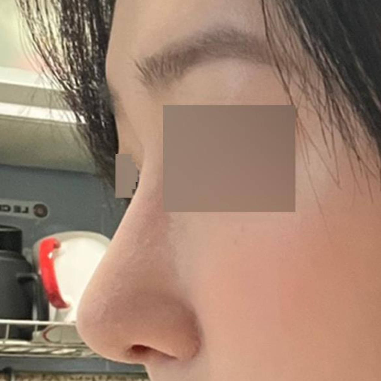 Mình đã lo lắng về việc phẫu thuật mũi lần đầu ở nhiều nơi và cuối cùng đã phẫu thuật mũi.