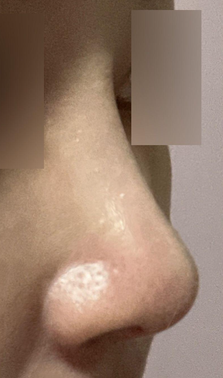 Đã 6 tháng kể từ khi phẫu thuật