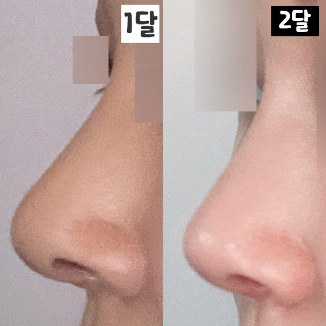 Đánh giá sau 2 tháng tái phẫu thuật mũi tại Weavers Plastic Surgery
