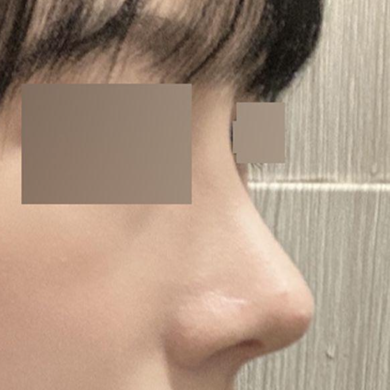 Mình đã phẫu thuật mũi gồ được 3 tháng rồi!