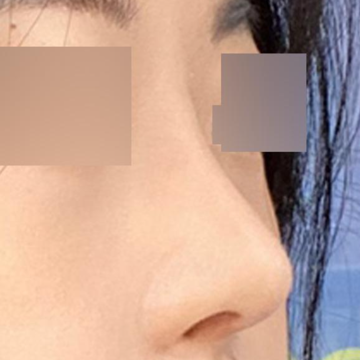 Mình rất hài lòng sau 2 tháng phẫu thuật.