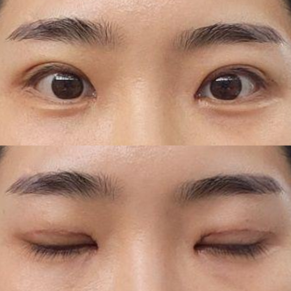 Mình đã phẫu thuật lại mắt được một tuần rồi