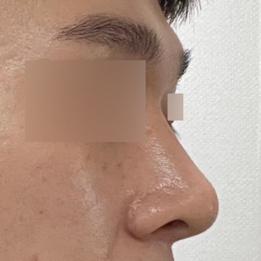 Mình đã phẫu thuật mũi với bác sĩ Seo Seung-jo được 2 tháng.