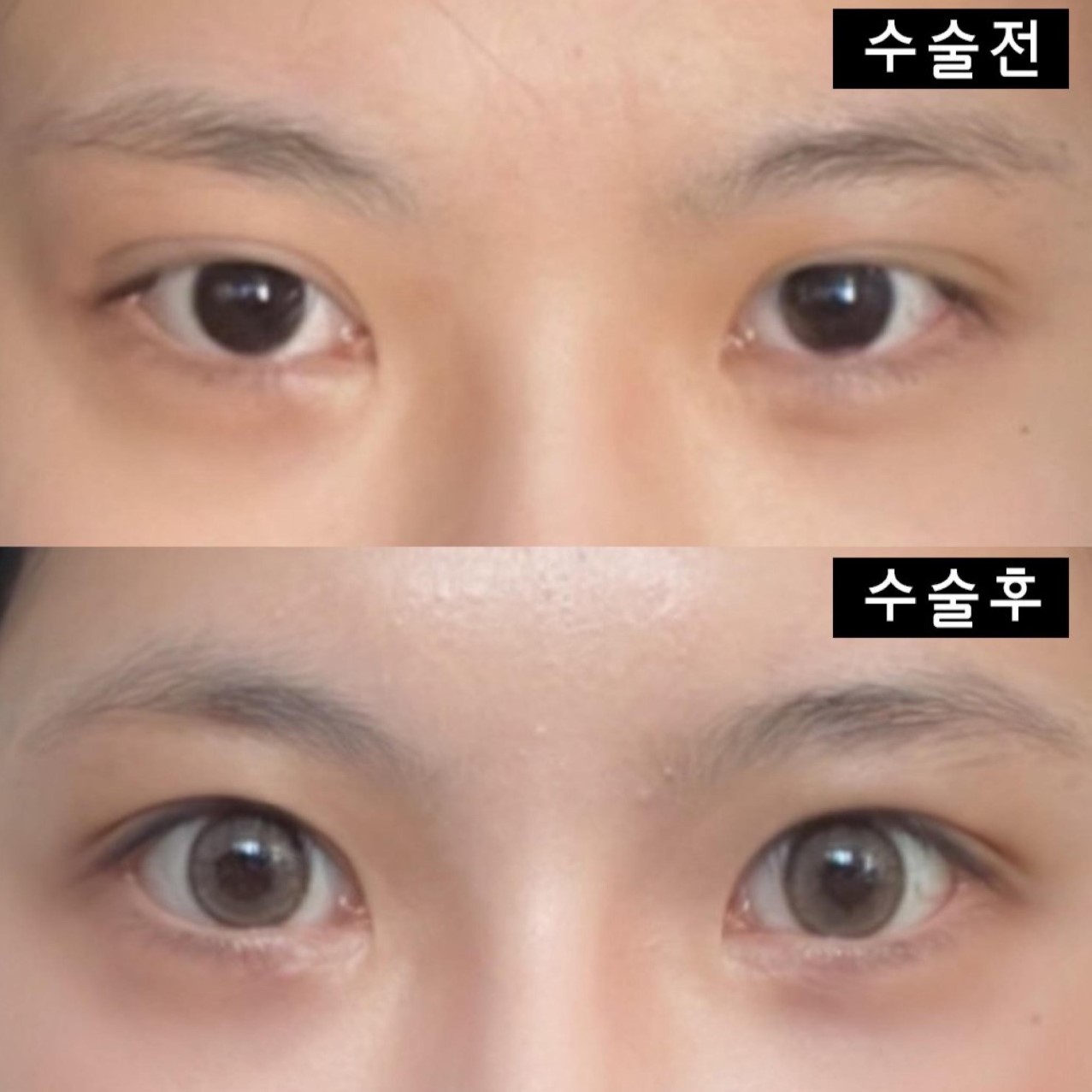 Đã hai tháng kể từ ngày mình phẫu thuật tại bệnh viện thẩm mỹ Weavers ~