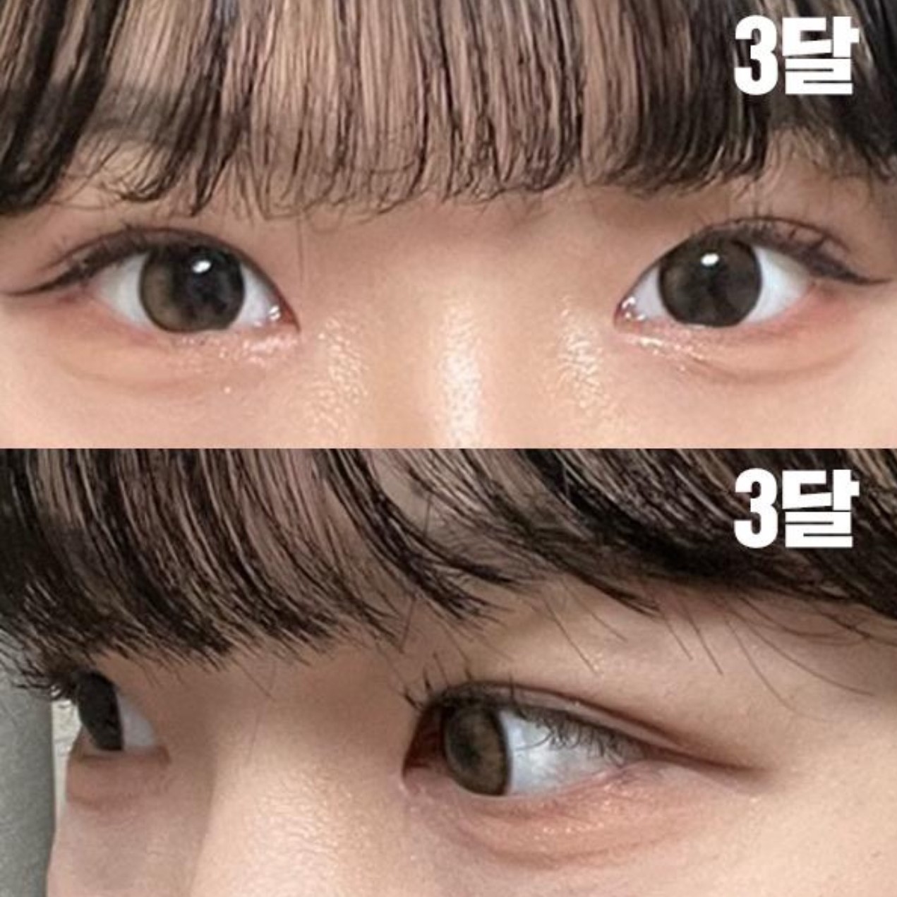 Mình đã phẫu thuật in-out line với bác sĩ Shim Jung Hwan.