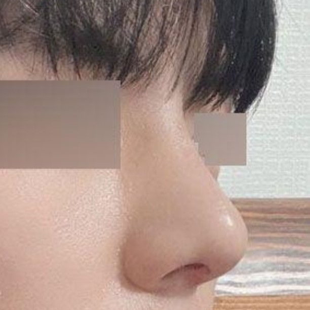 Mình đã phẫu thuật vừa để chữa viêm mũi vừa để chăm sóc bản thân