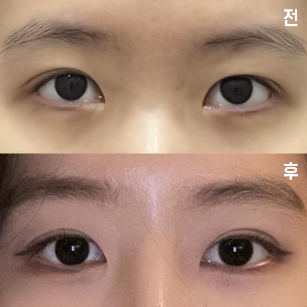 Mình đã phẫu thuật tại bệnh viện thẩm mỹ Wevers được 1 tháng rồi ~!