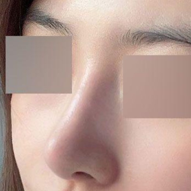 Đã được 3 tháng kể từ khi phẫu thuật lại mũi và không có gì xảy ra ㅎㅎ