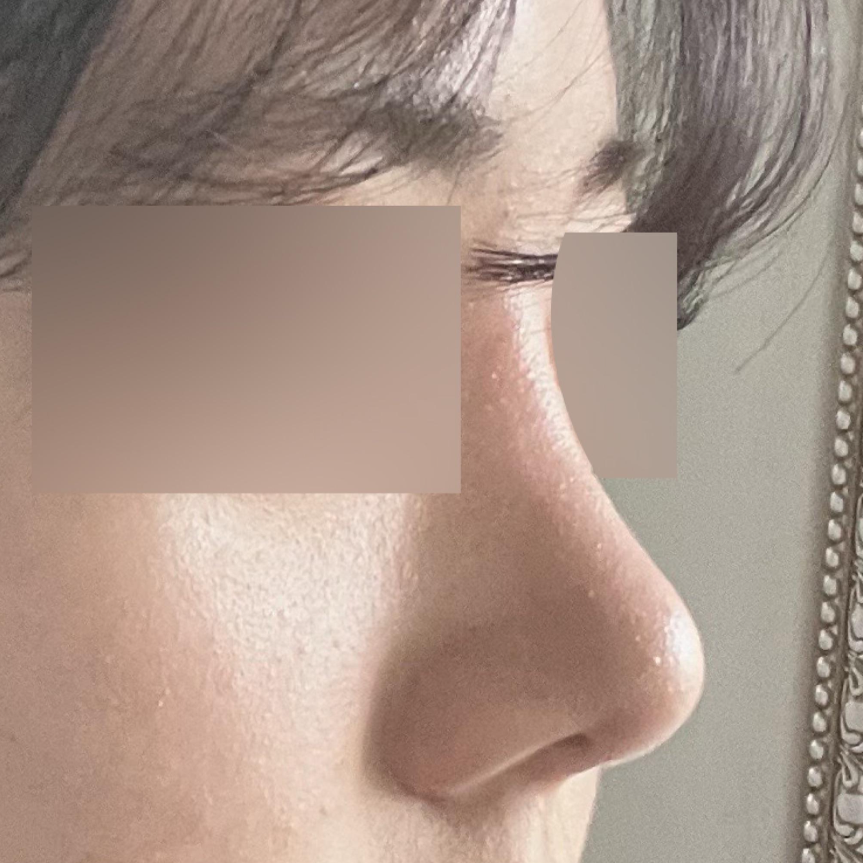 Tái phẫu thuật mũi thì Webers là đỉnh nhất