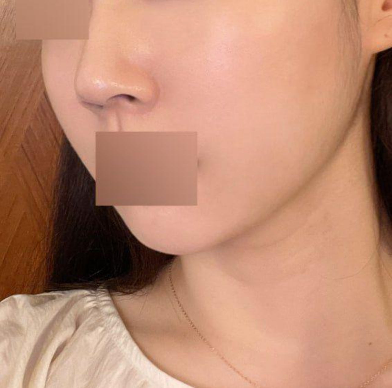 Đường nét khuôn mặt đã được cải thiện rất nhiều, trông trẻ hơn vài tuổi. Thật tuyệt.