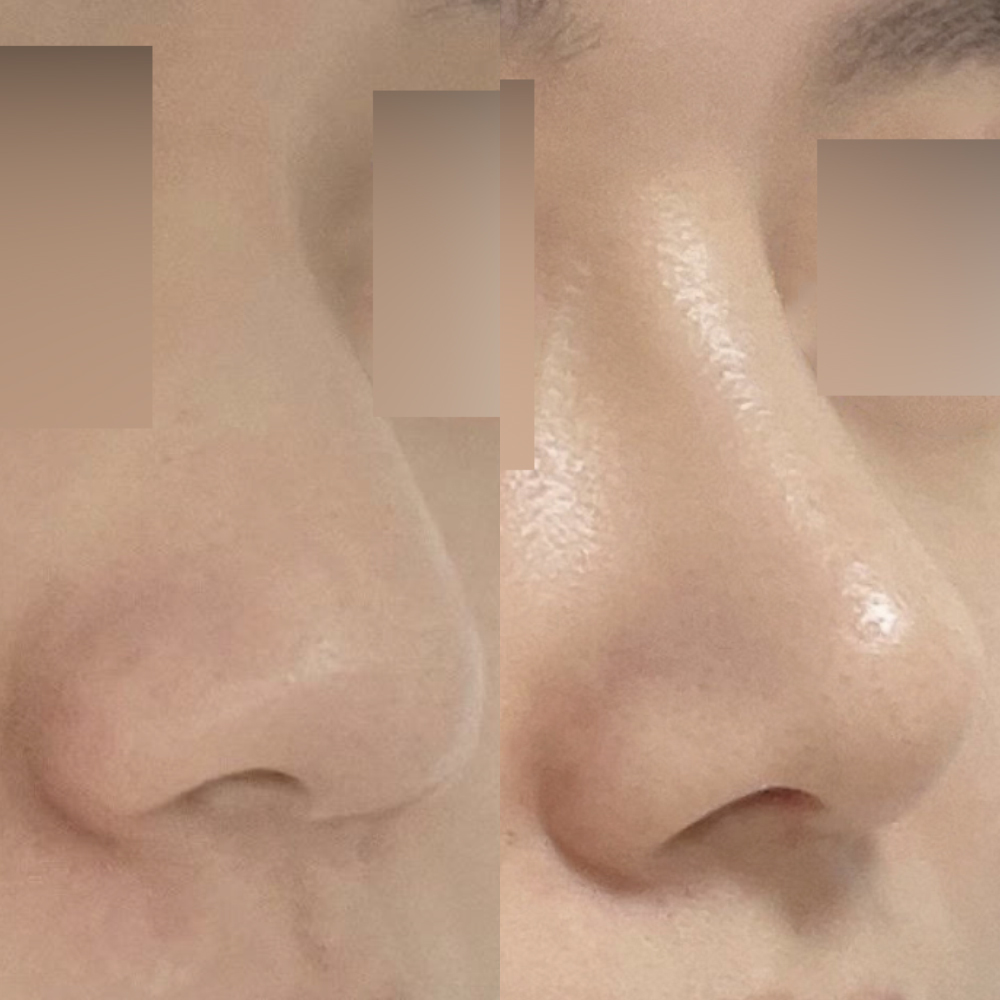 Mình đã phẫu thuật mũi tẹt không dùng chất liệu độn