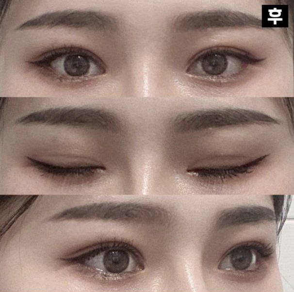 Mình trở nên xinh đẹp hơn trước khi phẫu thuật nên mình rất thích và hài lòng!