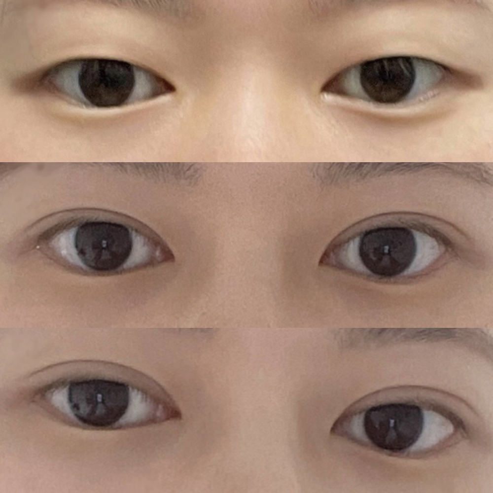 Thành công với đường mí mỏng nhờ cắt mí