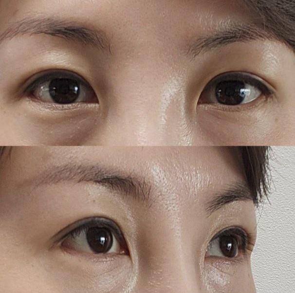 Nghĩ đến thôi đã thấy rất phấn khích! Mình nghĩ mình đã làm rất tốt khi phẫu thuật