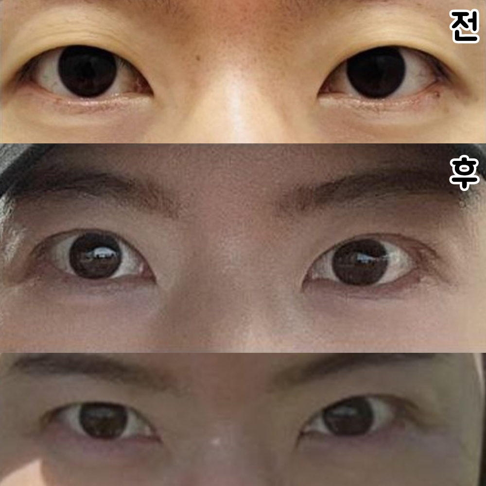 Bác sĩ làm cho mình rất đẹp nên mình rất hài lòng