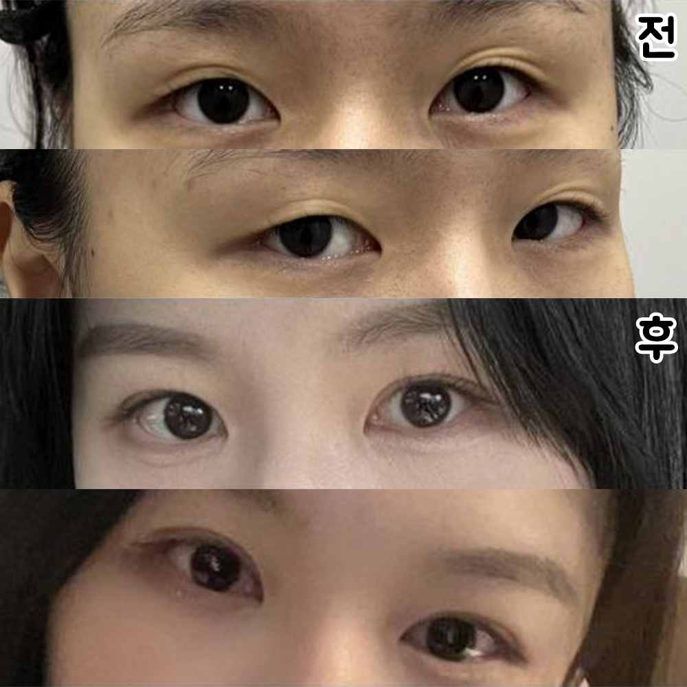 Bác sĩ tạo đường mí phù hợp với mắt nên trông tự nhiên hơn hẳn.