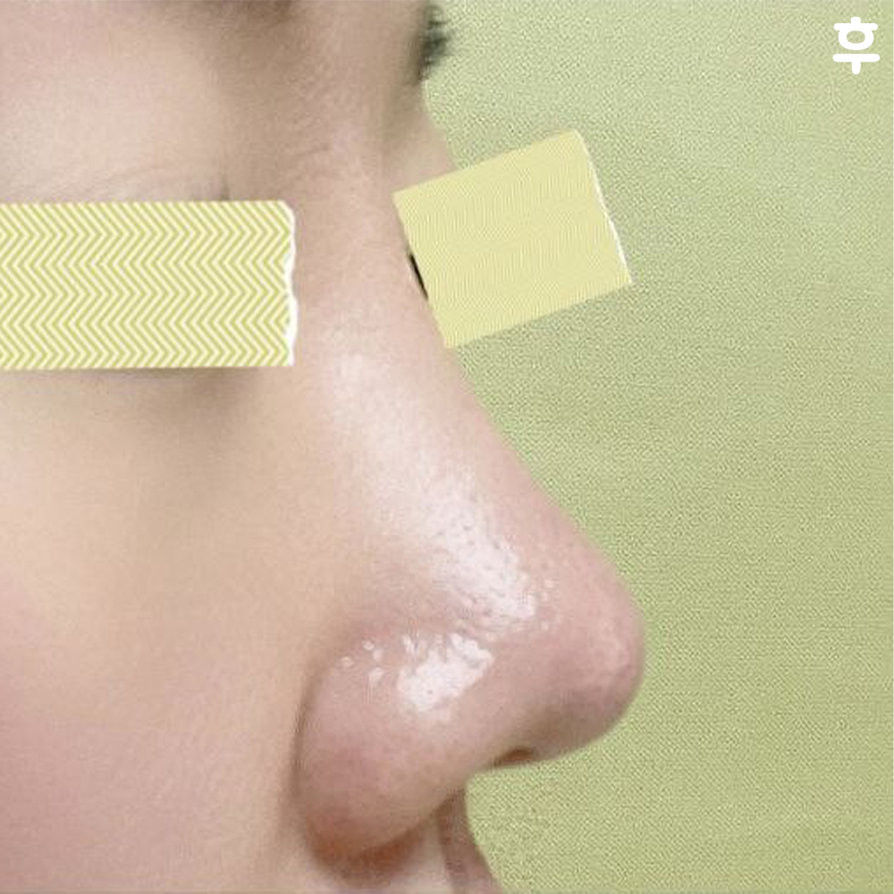 Mình nghĩ phẫu thuật mũi là một lựa chọn thực sự tốt trong cuộc đời mình!