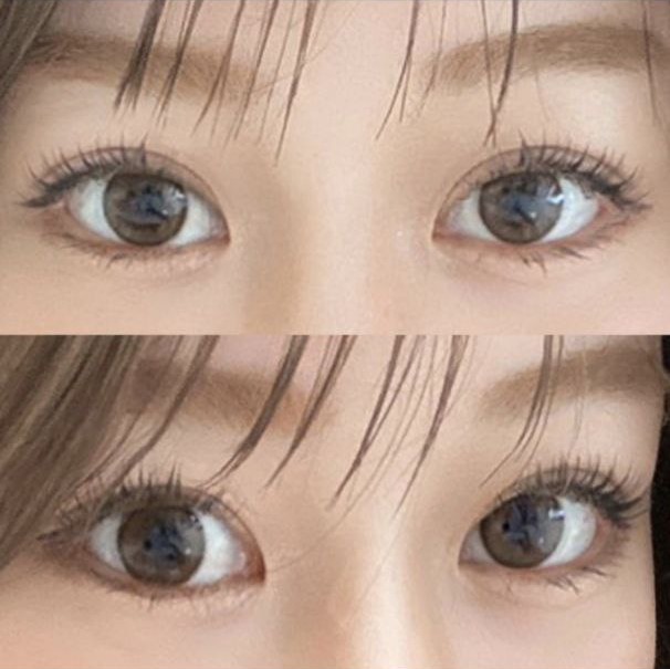 Không có điều trị quá mức và sau khi phẫu thuật cũng chăm sóc rất tốt nữa chứ ㅎㅎㅎ