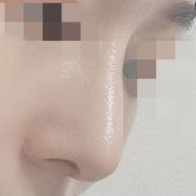 Mình đã có một chiếc mũi thẳng đẹp như mũi Oh Yeon Seo mà không cần cấy ghép!