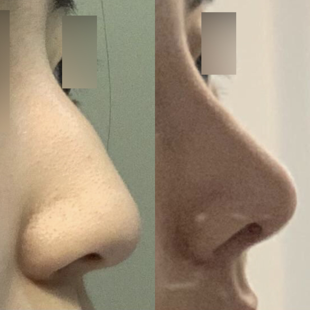 Mình đã phẫu thuật mũi diều hâu ㅎㅎ