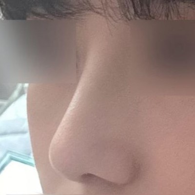 Mặc dù là ca phẫu thuật mũi đầu tiên nhưng mình vẫn vô cùng hài lòng đến 3728299393829%