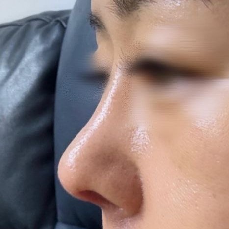 Mình đã lo lắng vì đầu mũi bị xệ xuống, nhưng mình rất vui vì mình đã có đầu mũi ^^